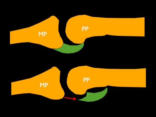 Rupture of flexor tendon following volar plate of