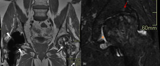 Fig. 1: IRM de hanches en coupes coronales, T1 (a) et STIR (b). (a) Prothèse totale de hanche droite (tête de flèche).  Séquelles d’infarctus osseux de topographie épiphysaire et diaphyso-métaphysaire avec ostéonécrose et déformation en coxa magna de l’extrémité supérieure du fémur gauche (flèche blanche). (b) Coxarthrose gauche secondaire avec épanchement intra-articulaire et œdème sous chondrale de l’os en zone portante sur le versant acétabulaire (flèche rouge).