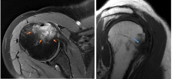 Sur l’IRM réalisée (DP Fatsat axial à gauche flèches oranges), présence d’un œdème du trochin centré sur une érosion corticale mieux visible sur la séquence T1 (à droite, flèche bleue).